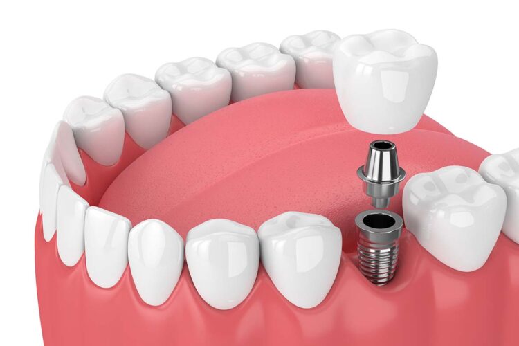 dental implants surgery