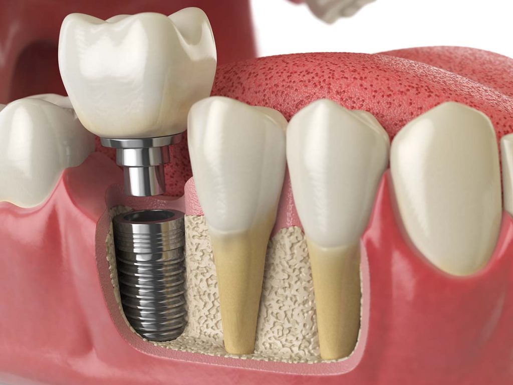 dental implants bone graft