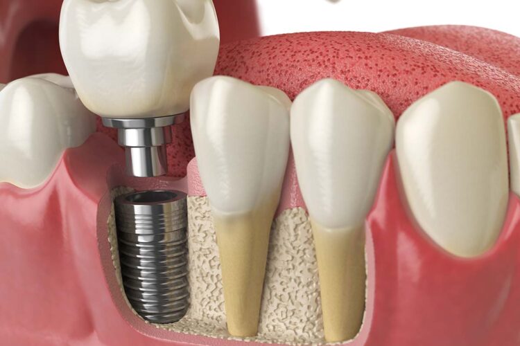 dental implants bone graft