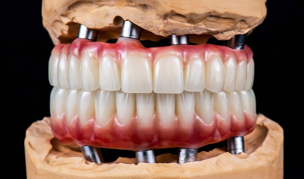 Full Mouth Dental Implants