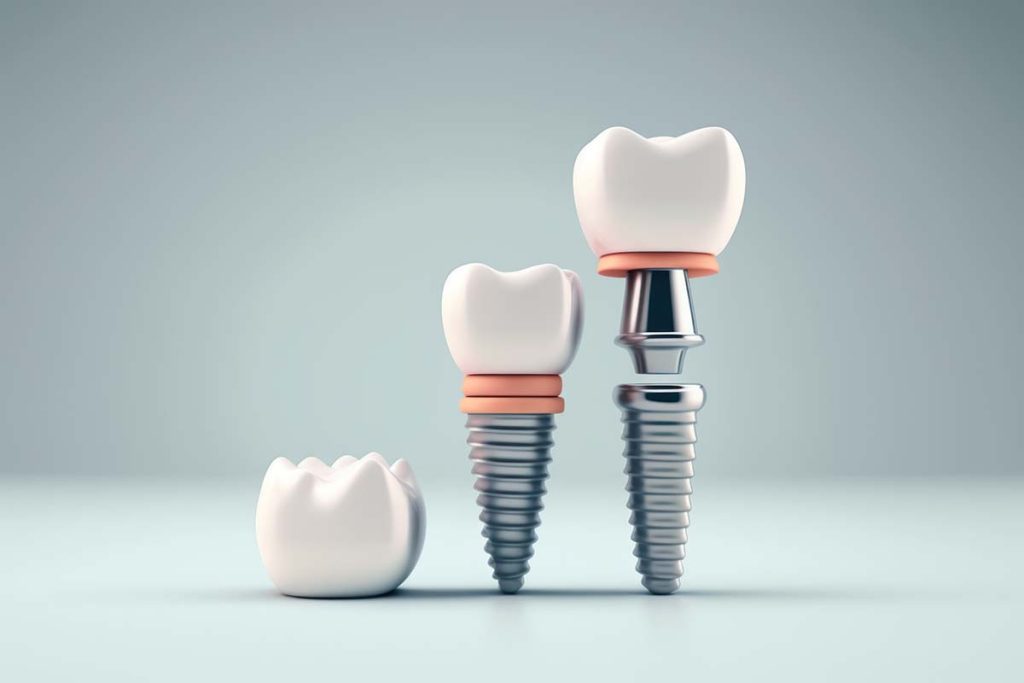 Benefits of Dental Implants