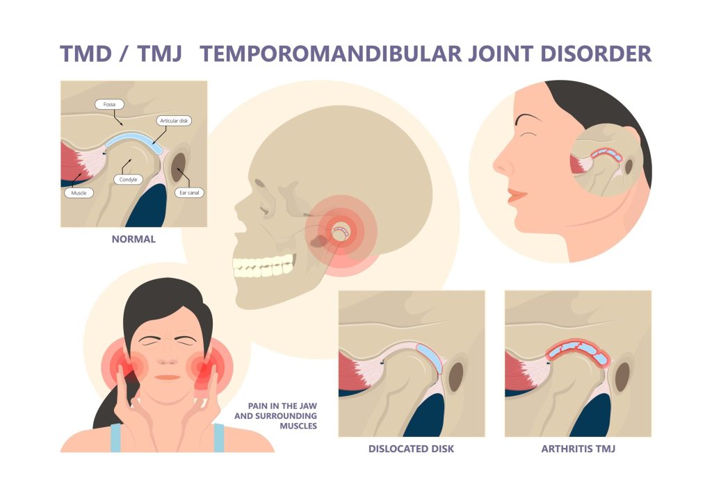 TMJ Specialist Los Angeles