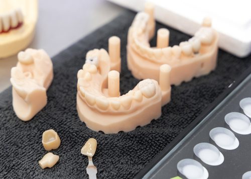 Dental Implants